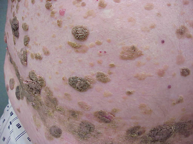 Seborrheic Keratosis Overview Perri Dermatology
