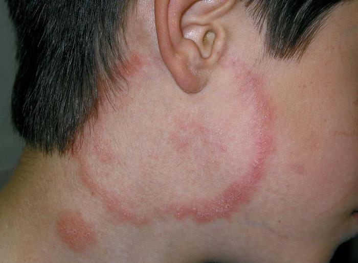 Pityriasis rosea (Christmas tree rash): Causes, Treatment ...