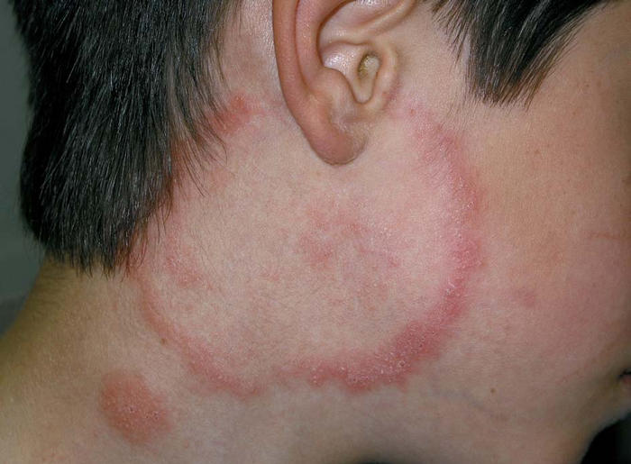 Hair follicle rash - Doctor answers on HealthcareMagic