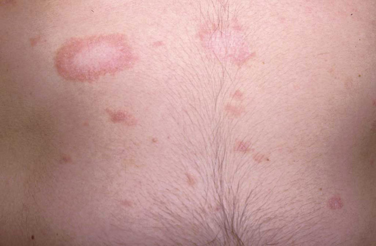 rash-pityriasis-rosea-perri-dermatology