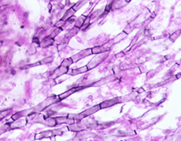 Aspergillosis- Histology 