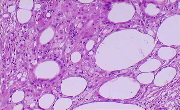 Sclerosing Lipogranuloma Histology