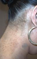 Partial unilateral lentiginosis | perri dermatology