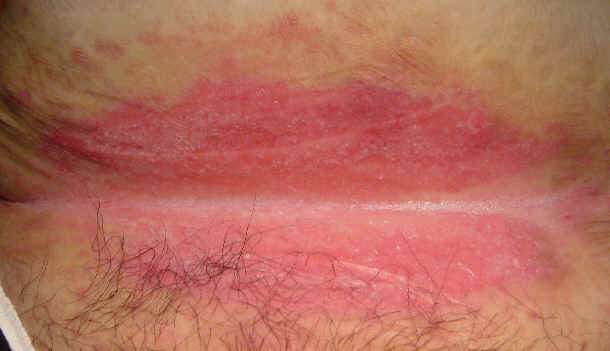 Red irritation in skin crease/fold on crotch