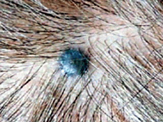 Cellular blue nevus | perri dermatology