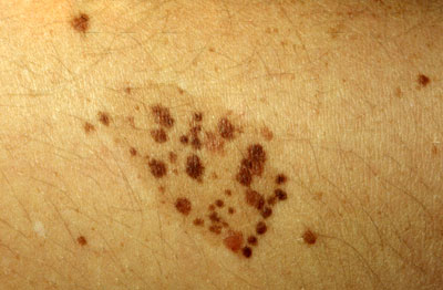 Close up of nevus spilus on skin