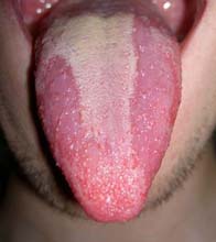 Human geographic tongue | perri dermatology