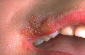 Oral herpes | perri dermatology