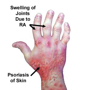 Psoriaticarthritissymptoms3 | perri dermatology