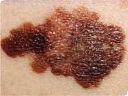Close Up of Skin Cancer Melanoma Mark