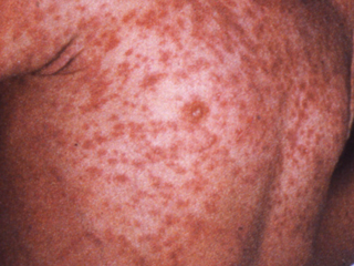 Measles- Morbilliform Rash 