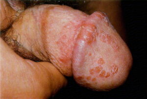 Close up of penis with seborrheic dermatitis | perri dermatology