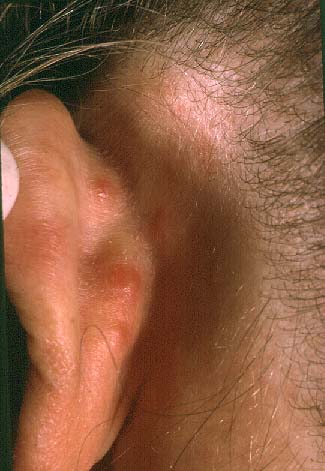 Angiolympoid Hyperplasia with Eosinophilia 