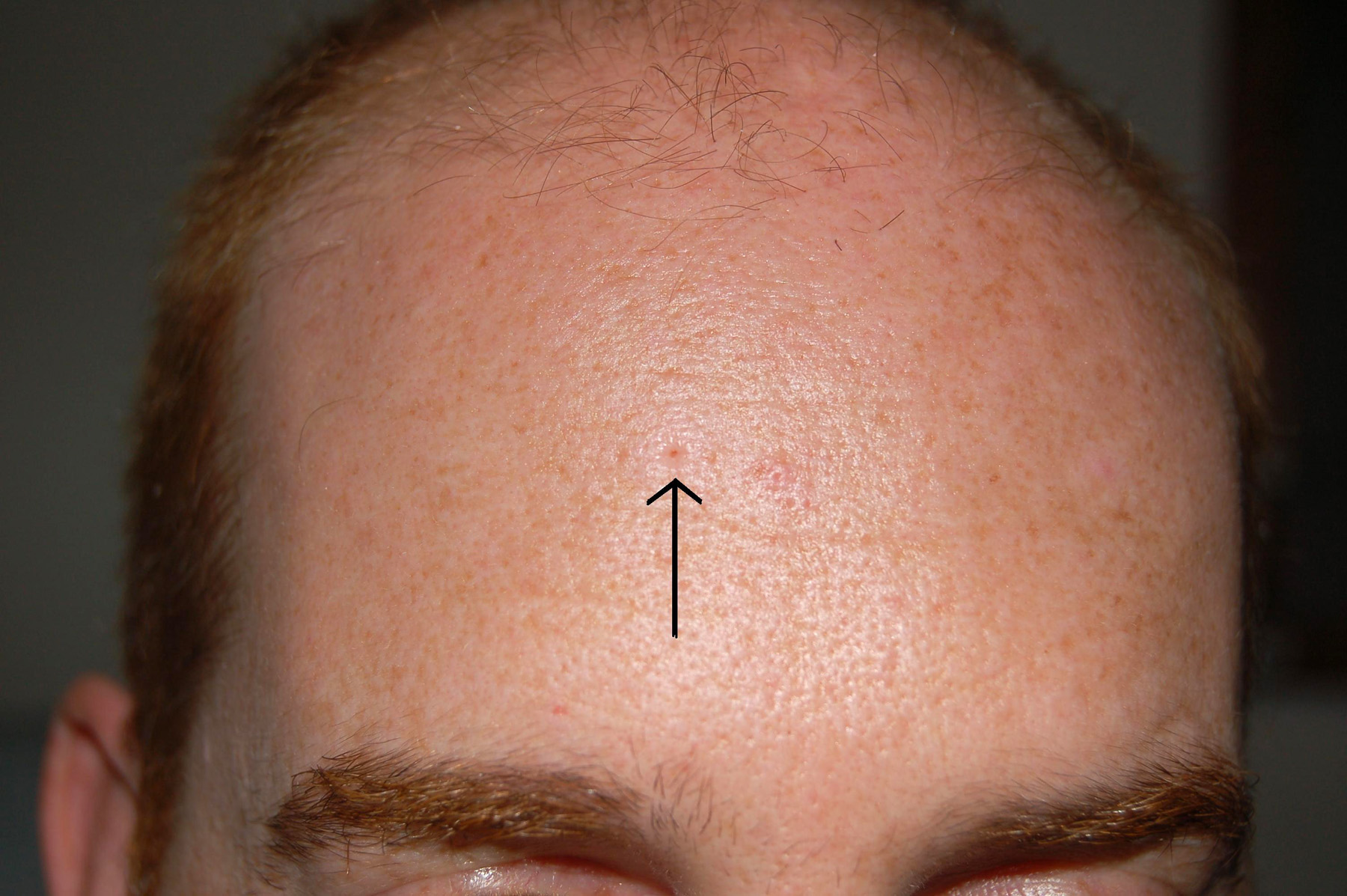 Dilated Pore of Winer - Perri Dermatology
