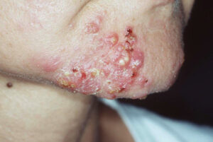 Close up of pyoderma faciale | perri dermatology
