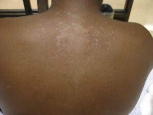 tinea versicolor before and after