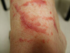 Close up of poison ivy dermatitis in heel | perri dermatology