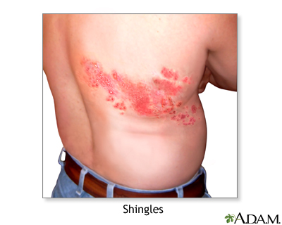 Shingles | perri dermatology
