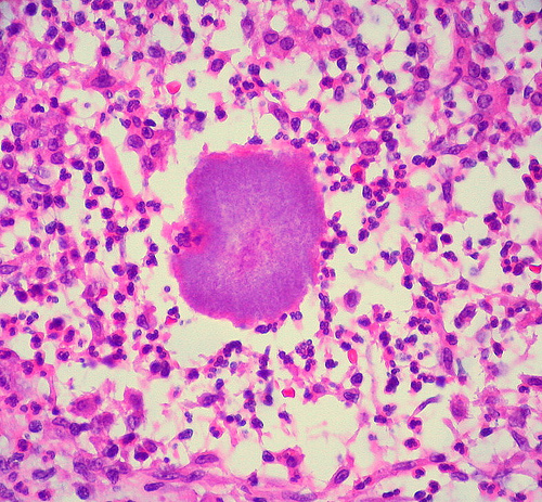 Mycetoma- Histology Showing Splendore Hoeppli Phenomenon 