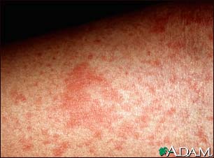 Nummular Eczema 