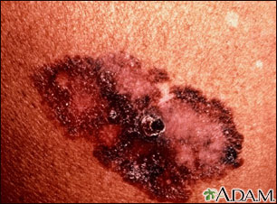 Superficial spreading melanoma | perri dermatology