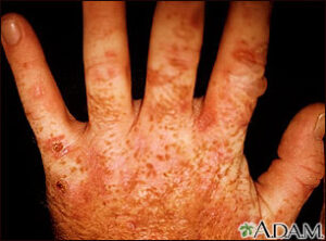 Hepatitis c  porphyria cutanea tarda | perri dermatology