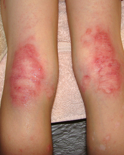 Eczema | perri dermatology
