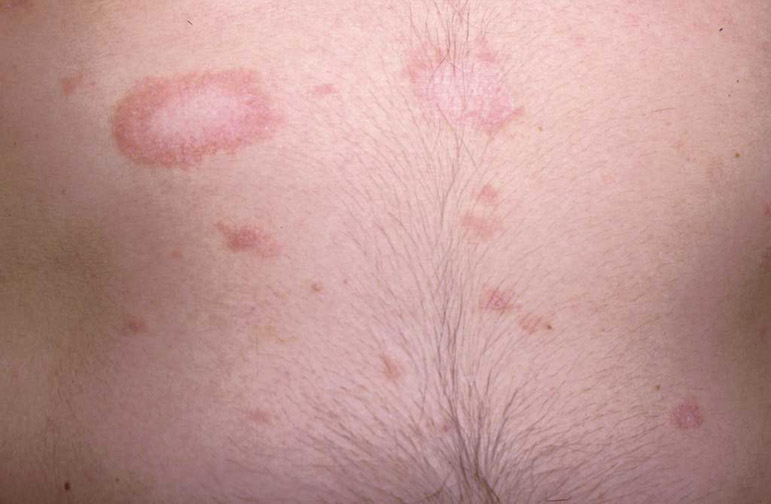 Pityriasis Rosea- Herald Patch
