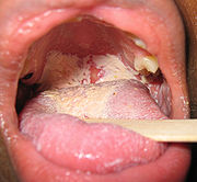 Geotrichosis- Mucocutaneous disease 