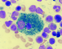 Sea Blue Histiocyte 