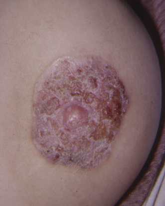 Nipple Eczema 