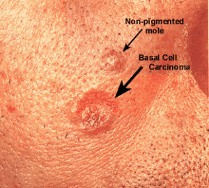 Basal Cell Cancer