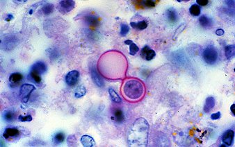 Blastomycosis- Broad Based Buds on Histology 