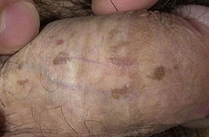 Close up of bowenoid papulosis | perri dermatology