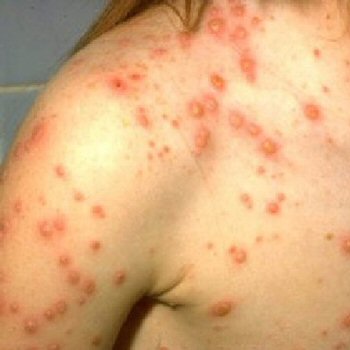 Chickenpox | perri dermatology