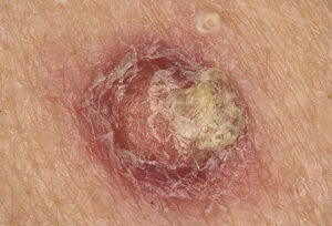 Close up of squamous cell cancer