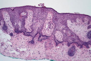 Histology of tumor of follicular infundibulum with plate like growth | perri dermatology