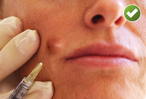 Acne cyst injection | perri dermatology