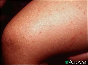 Gionatti crosti syndrome | perri dermatology