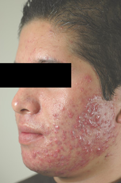 Photodynamic therapy of acne | perri dermatology