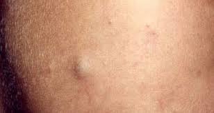 Epidermal Inclusion Cyst