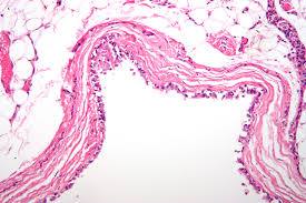 Bronchogenic Cyst- Histology