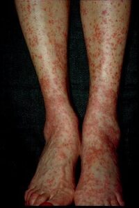 Close up of hepatitis c  cryoglobulinemia | perri dermatology