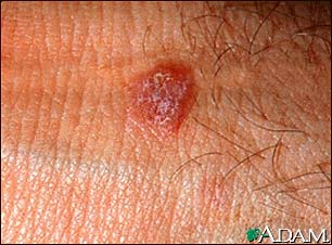 Hepatitis C- Lichen Planus 