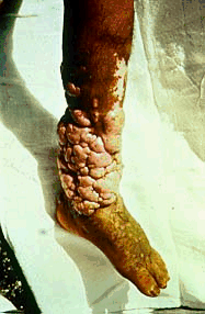 Keloidal Blastomycosis- 
