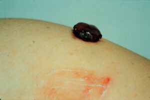 Nodular Melanoma