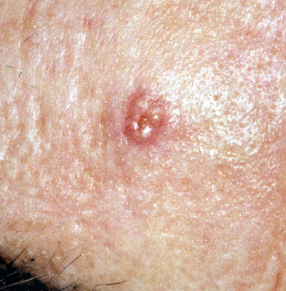 Sebaceous adenoma | perri dermatology