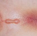 Median Raphe Cyst