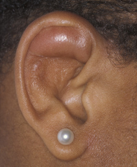 Pseudocyst of the Auricle