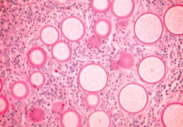 Rhinosporidiosis spherules on histology | perri dermatology